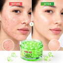 NEU| ANTI PIMPLE PEARLS - KOREAN SKINCARE
